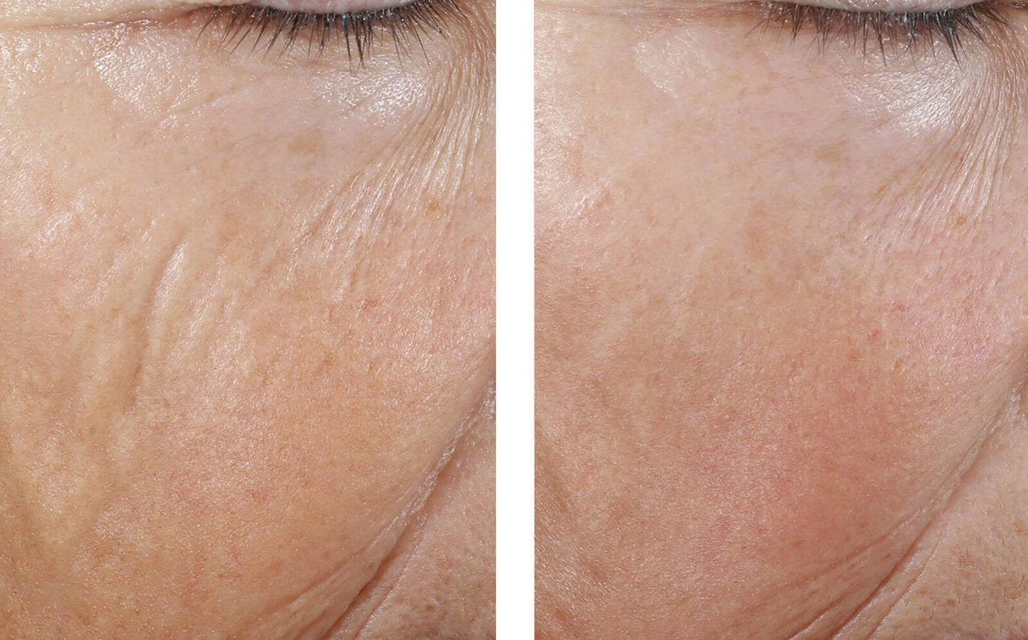 Interfuse Intensive Treatment Lines